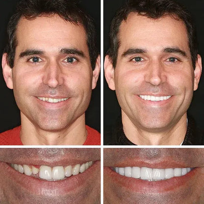⏰Ends Today: 70% OFF! 🌎LUMIVO™ Custom-Fit Dentures— Designed for Comfort and a Natural-Looking Smile
