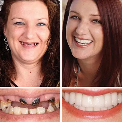 ⏰Ends Today: 70% OFF! 🌎LUMIVO™ Custom-Fit Dentures— Designed for Comfort and a Natural-Looking Smile